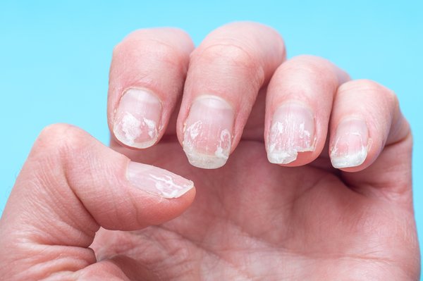 Top 5 remèdes naturels efficaces pour les ongles dédoublés
